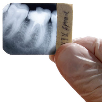 Dental X-Rays May Raise Risk of Brain Tumor