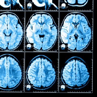 Concussion Correlates with Abnormal Brain Structural Patterns