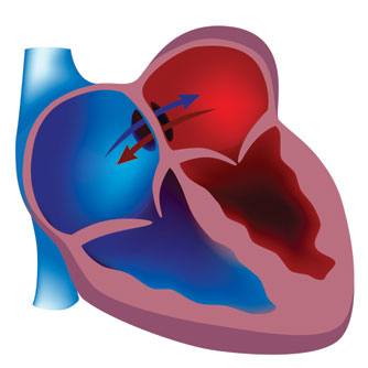 Doppler Detects Heart Defect