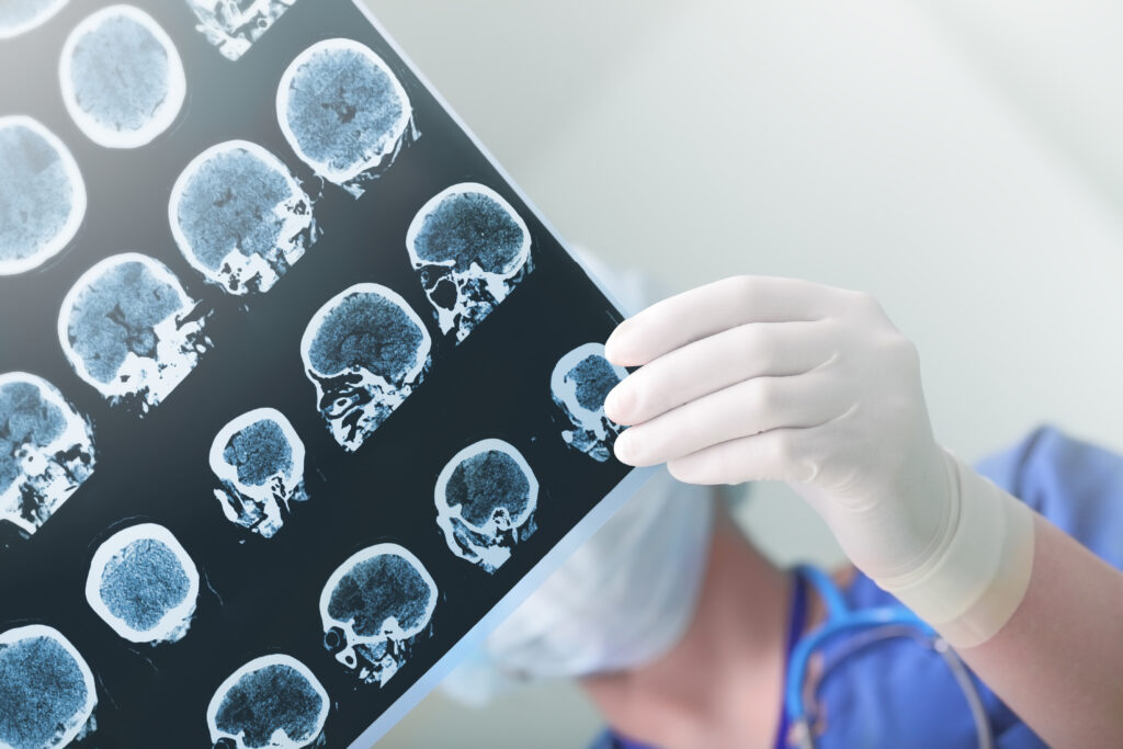 Single brain scan can diagnose Alzheimer's disease