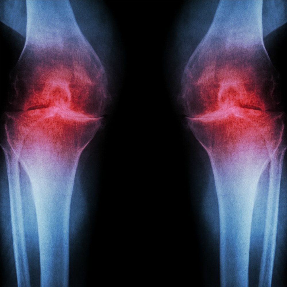 Artificial Intelligence Searches An Early Sign Of Osteoarthritis From An X-Ray Image