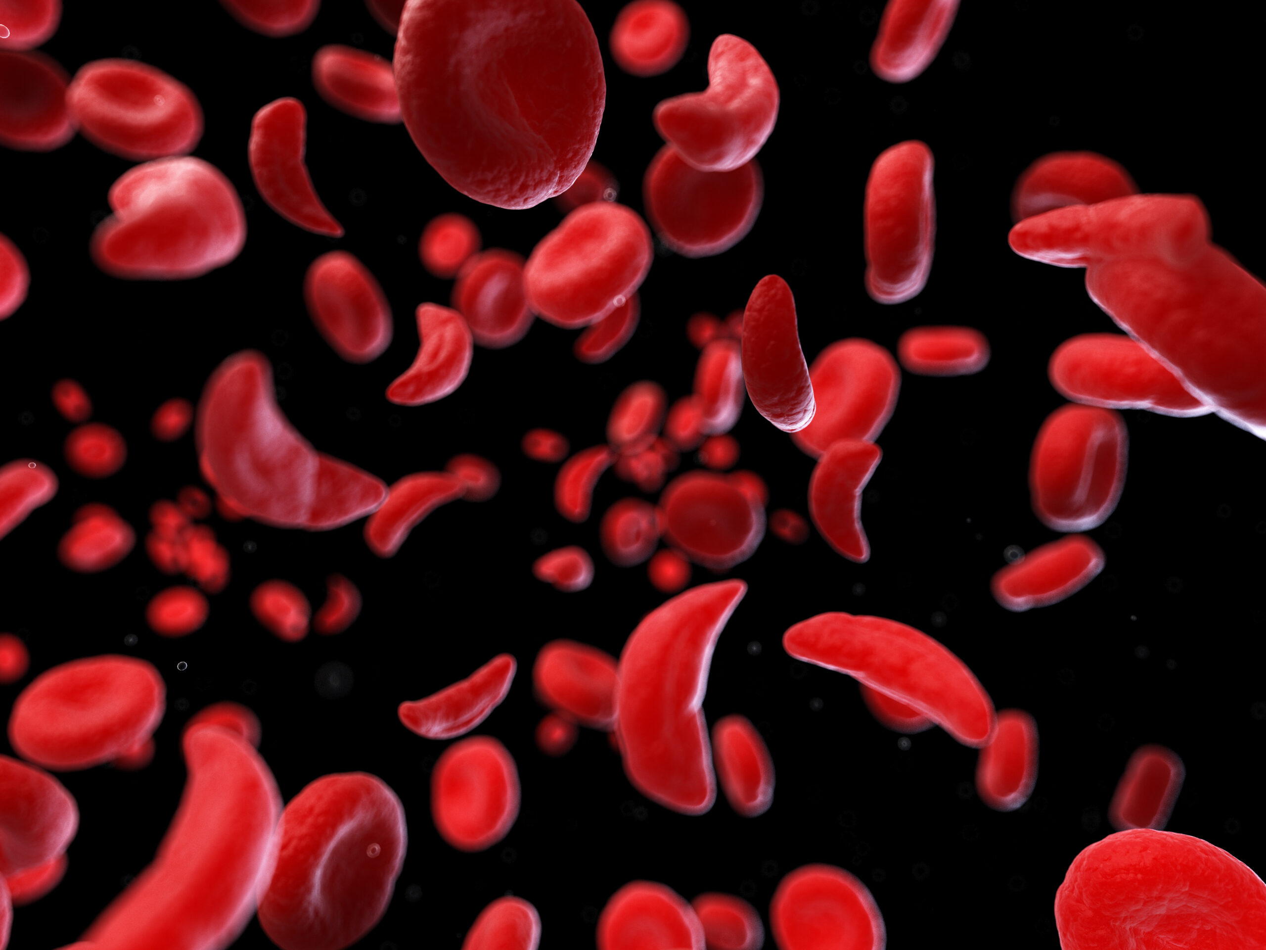 Battling Bent Blood Cells: Progress in Sickle Cell Disease