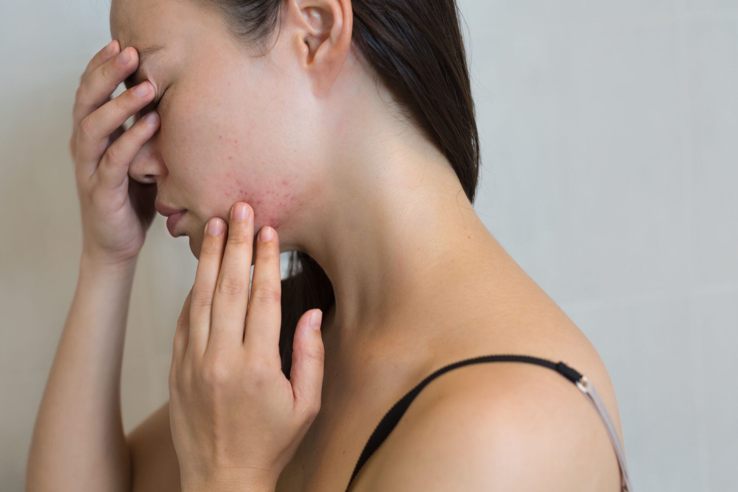 FDA Approved A New Active Ingredient To Target Hormonal Acne