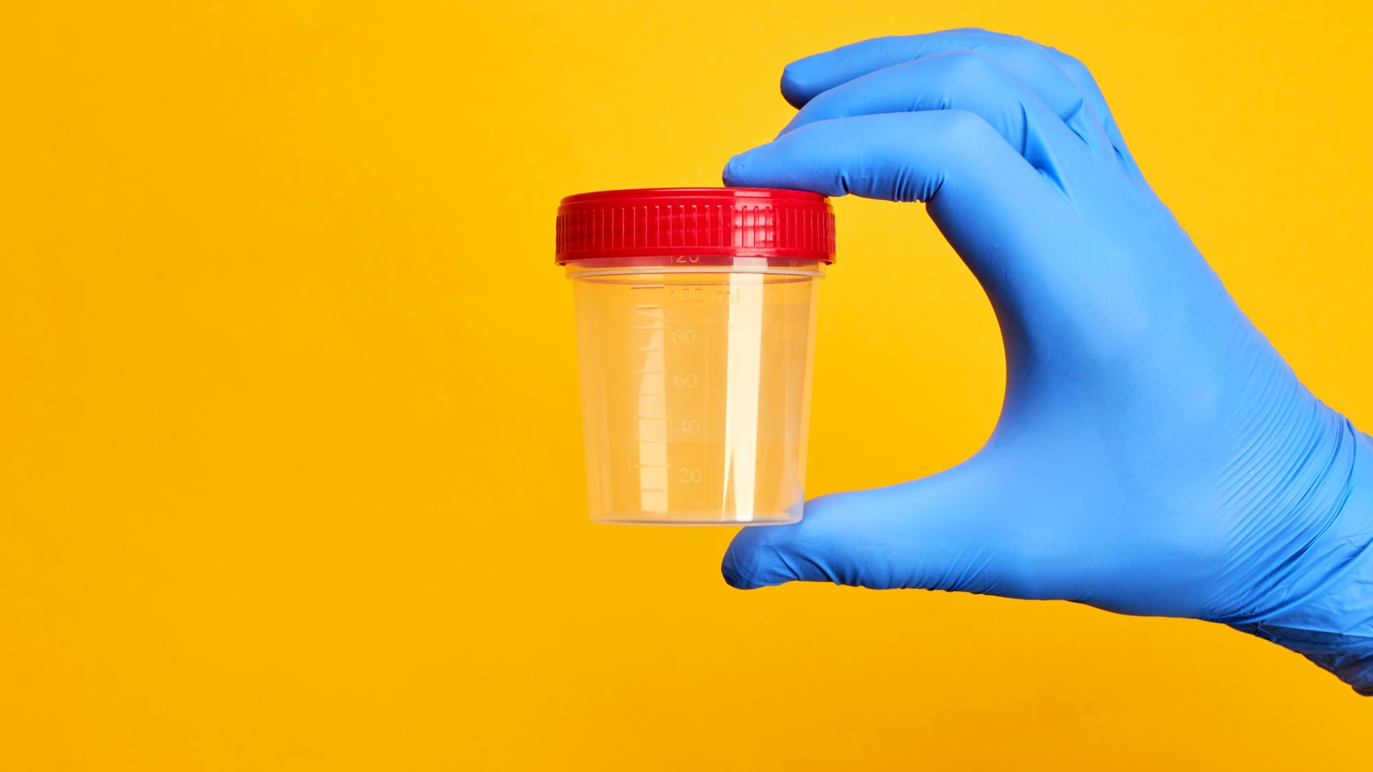 New urine-based test detects high-grade prostate cancer, helping men avoid unnecessary biopsies