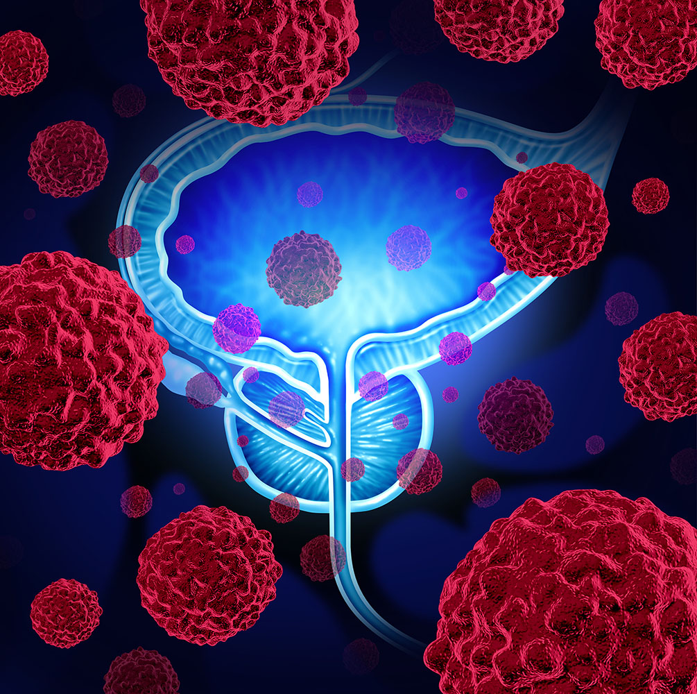 Cellular Protein Uncovered For The Treatment Of Prostate Cancer
